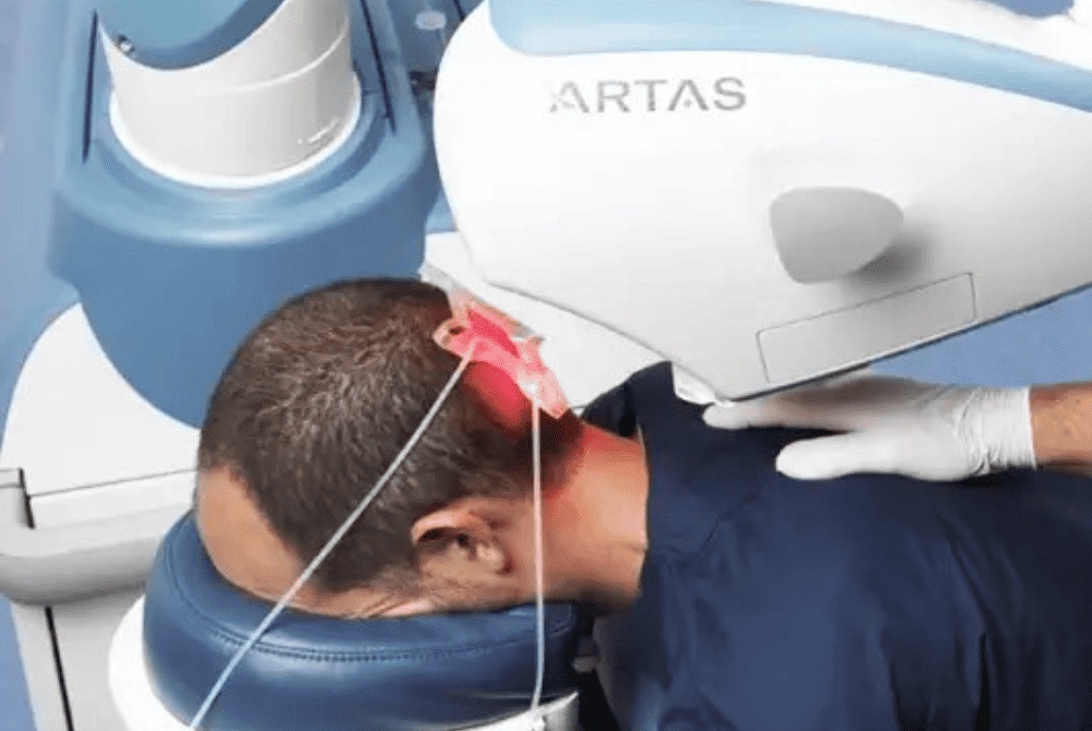 Why Choose Robotic Hair Transplant at Estheticare Clinic?