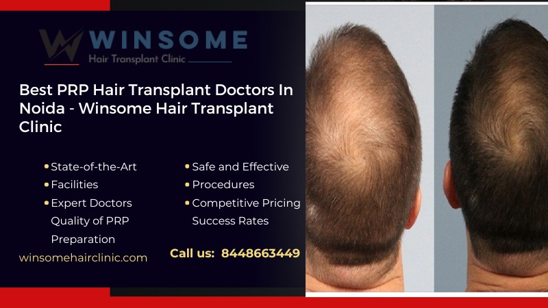 Best PRP Hair Transplant Doctors In Noida – Winsome Hair Transplant Clinic