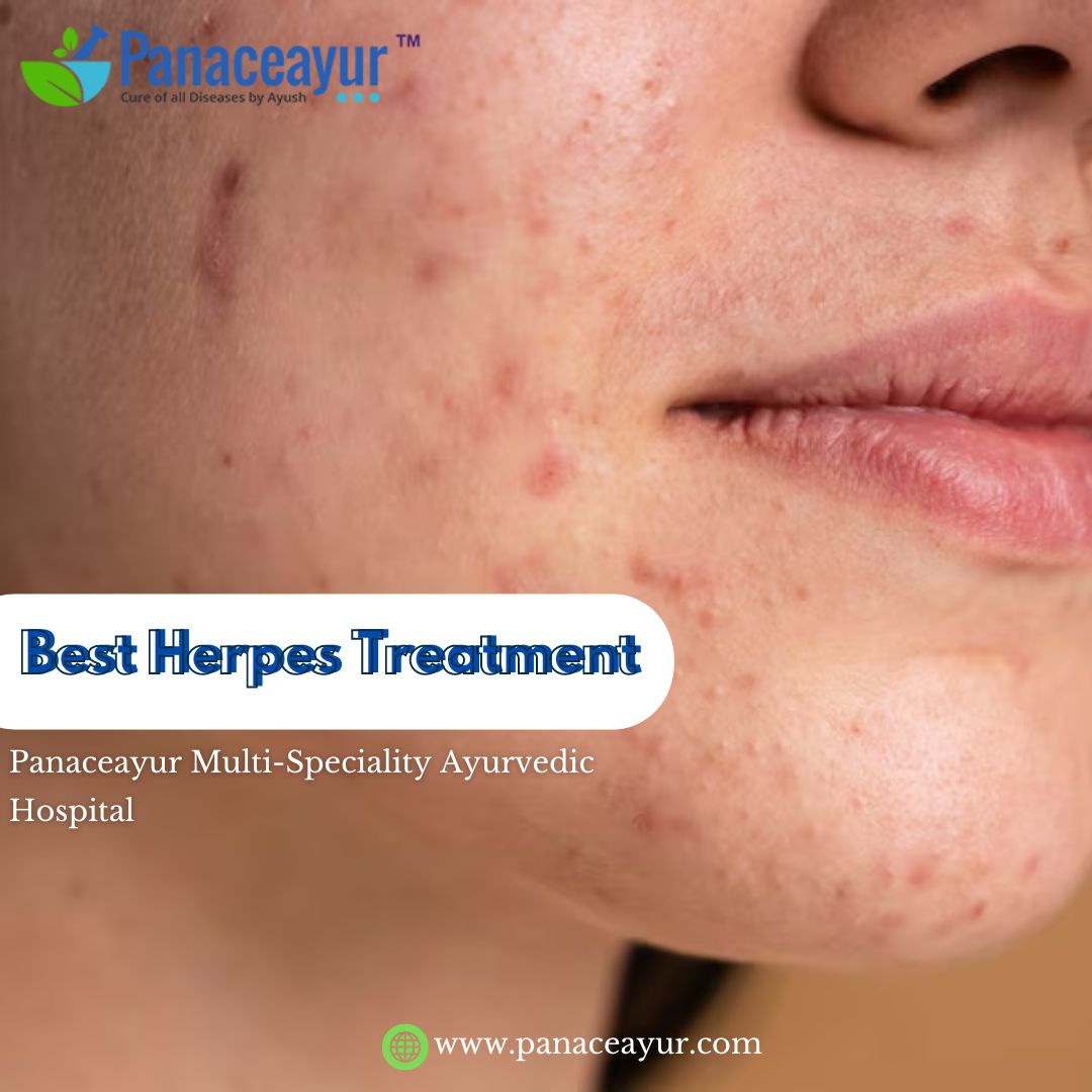 Unveiling Hope The Path to the Best Herpes Treatment at Panaceayur Multi-Speciality Ayurvedic Hospital