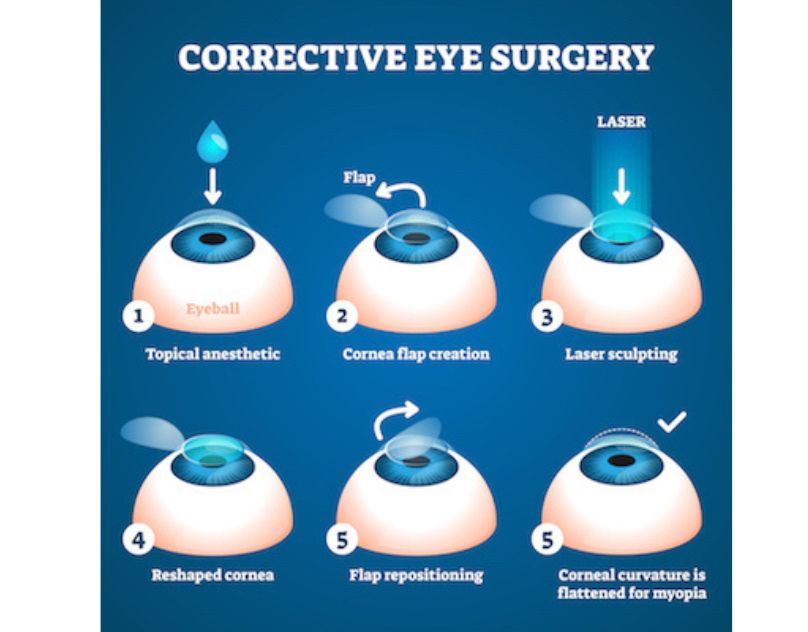Top 9 Tips to Prevent Dry Eyes after Lasik Eye Surgery