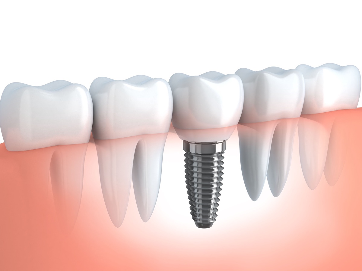 The Benefits of Dental Implants over Traditional Dentures