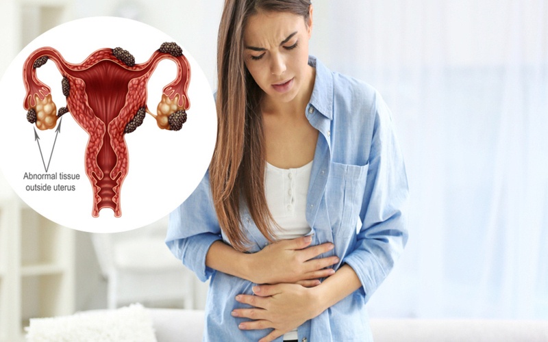 Understanding Endometriosis, Symptoms And Its Treatment Options
