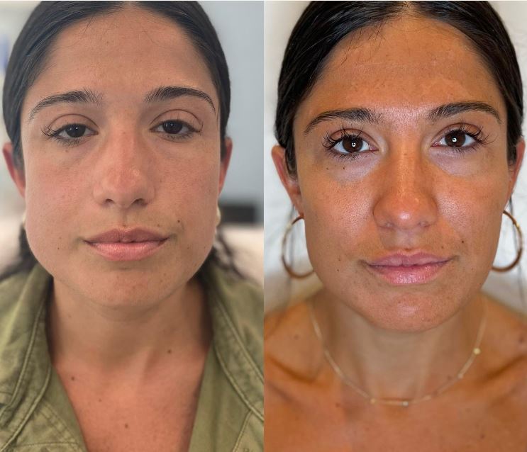 Lip Filler in Island Park