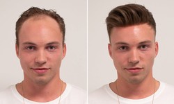 Hair Systems For Men
