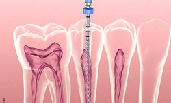 How to avoid damage to the apical stenosis during root canal preparation?