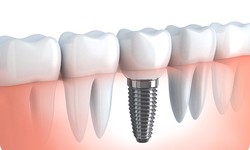 Is a dental implant a permanent solution to a missing tooth?