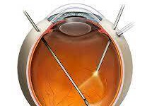 What Is Vitrectomy? – Bharti Eye Foundation
