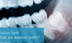 Find here everything to know about wisdom teeth