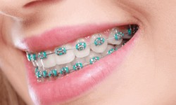 Dental Braces Technology Advancements