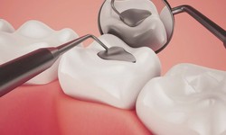 How Long Should A Dental Filling Last?