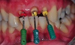 Dentists Near Me: Find The Best Dentist For Root Canals