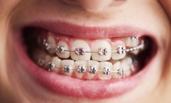 Where To Find An Orthodontist For Braces Near Me?