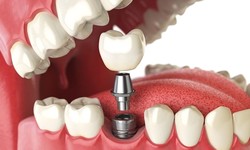 How Much Does It Cost To Get Dental Implants Near Me?