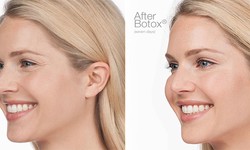How Botox Makes You Look Younger?