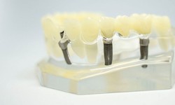 What are the advantages of dental implants near me?