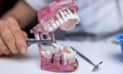 Improve Your Smile and Gain Functionality With Dental Bridges