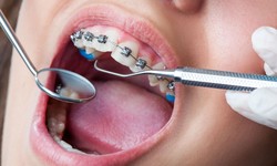 Why Lingual Braces Could Be The Right Choice For Your Smile Makeover?