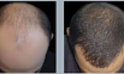 Here is Why Hair Transplants are an essential service
