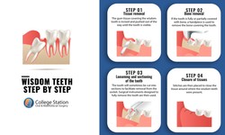 Should You Get Your Wisdom Teeth Removed? Here Are 4 Reasons Why You Might Want to Consider It