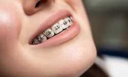 What Your Dentist Can Tell You About Dental Braces