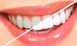 Teeth Whitening Treatment in Delhi – Why You Should Try it!