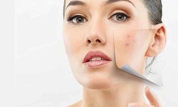 What Treatment Are for Dark Spots and Blemishes on Skin