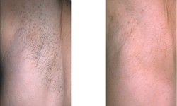 How Painful Is Laser Hair Removal?