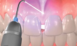Laser technology in orthodontics: Benefits and limitations