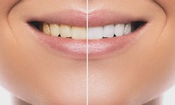 Tips To Get Rid Of Yellow Teeth - How To Get Rid Of Yellow Stains From Teeth