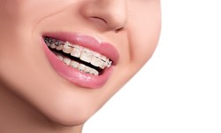How Lingual Braces Can Bring About A Change In Your Personality?