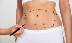 Liposuction: The Results We Can Promise