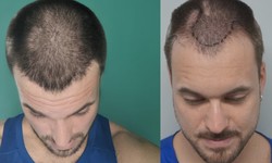 How Hair Restoration Gave Me Back My Confidence: A True Story