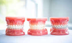 What are The Braces for and How to Find The Right Braces in Sydney?