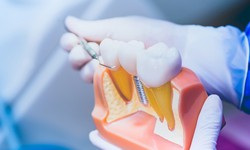 What Is the Best Option for Replacing Missing Teeth Treatment?