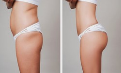 Liposuction Colombia cost: Why Should you Get the Treatment