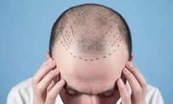Who is The Best Hair Transplant Surgeon?