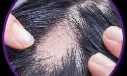 Find The Reputed Doctors For Hair Fall Treatments In Waghbil!