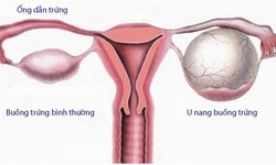 Bệnh u nang đơn thuỳ buồng trứng và thuốc điều trị