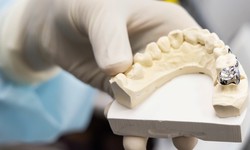 Why You Should Consider a Dental Crown from Tuscan Lakes Family Dentistry