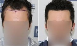 Why is FUE Implantation Successful?