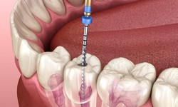 Smile Confidently with Dental Implants: A Long-Term Investment in Your Oral Health