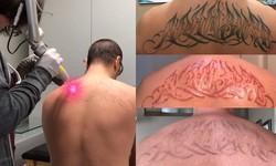 Laser Tattoo Removal: How To Remove A Tattoo With A Laser