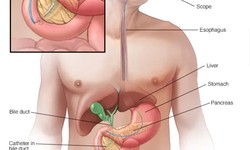 Impacts of Gallbladder Evacuation - Stay away from Disease and Normally Flush Gallstones