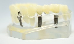 Dental Implants: The Different Types You Should Know About