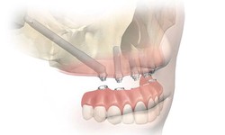 How Can Zygomatic Implants Help Patients With Jaw Bone Loss?