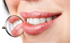 4 Myths And Facts About Best Painless Teeth Whitening Service In The Summit