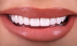 Why Is Dental Bonding Necessary?
