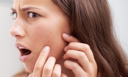 Find out All You Need to Know about Acne & Acne Anti-Aging Treatment