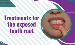 Treatments for the exposed tooth root