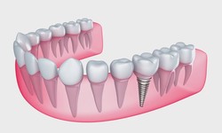 A Dental Implant Is A Teeth Root Replacement